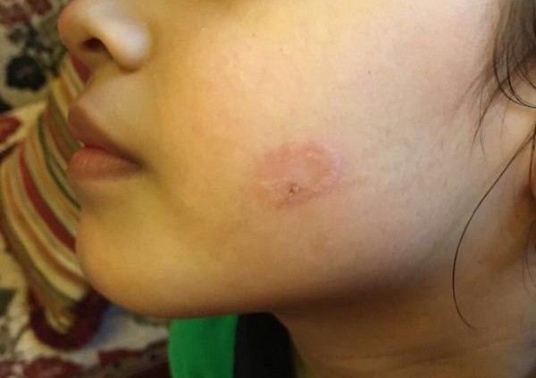 معلمة تعنف أطفال بالحرق في أحد مدارس الرياض